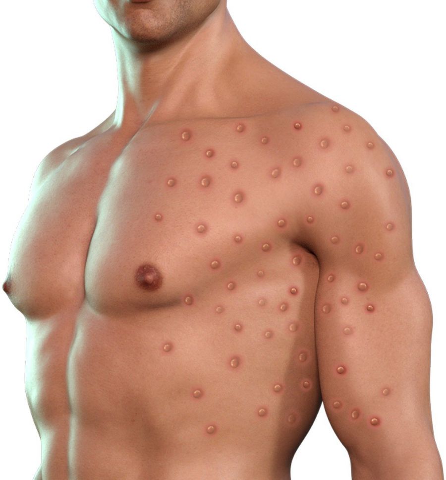 To Stem the Spread of Monkeypox Health Departments